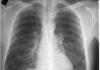 Uzroci, simptomi i liječenje hroničnog bronhitisa Šta znači hronični bronhitis