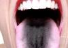 Warum hat ein Mensch eine schwarze Zunge?