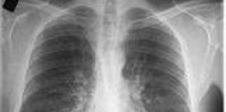 Uzroci, simptomi i liječenje hroničnog bronhitisa Šta znači hronični bronhitis?