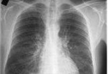 Uzroci, simptomi i liječenje hroničnog bronhitisa Šta znači hronični bronhitis