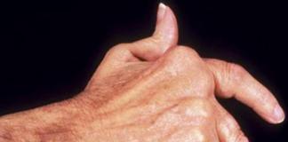 Príčiny a liečba zápalu kĺbov prstov Príčiny zápalu kĺbov prstov