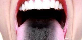 体の病気の指標としての舌の斑点